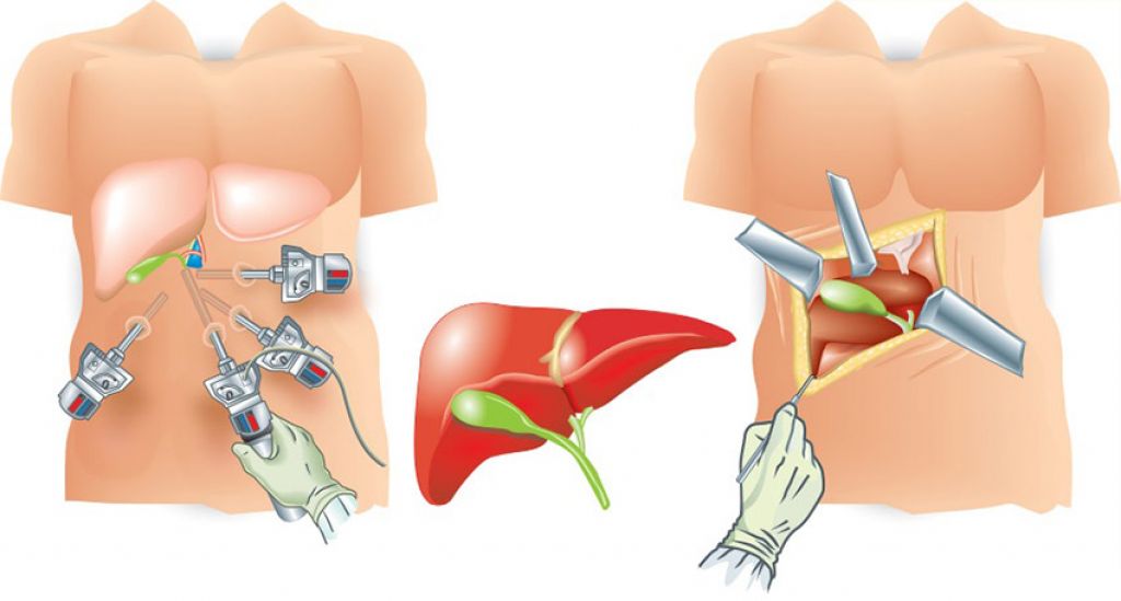 Можно печень после удаления желчного пузыря. Холецистит и лапароскопическая холецистэктомия. ЖКБ лапароскопическая холецистэктомия. Желчекаменная болезнь лапароскопия. ЖКБ операция лапароскопия.