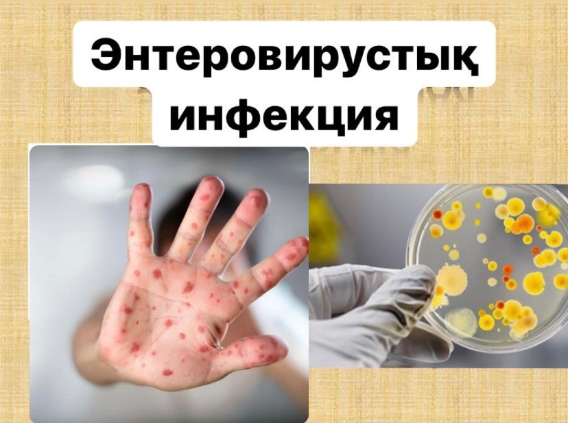 Энтеровирустық инфекция