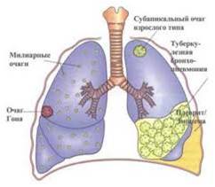 Туберкулез: белгілері, емі, алдын-алу.