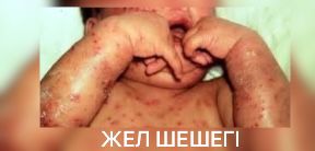 Жел шешегі – инфекция туралы не білу керек?