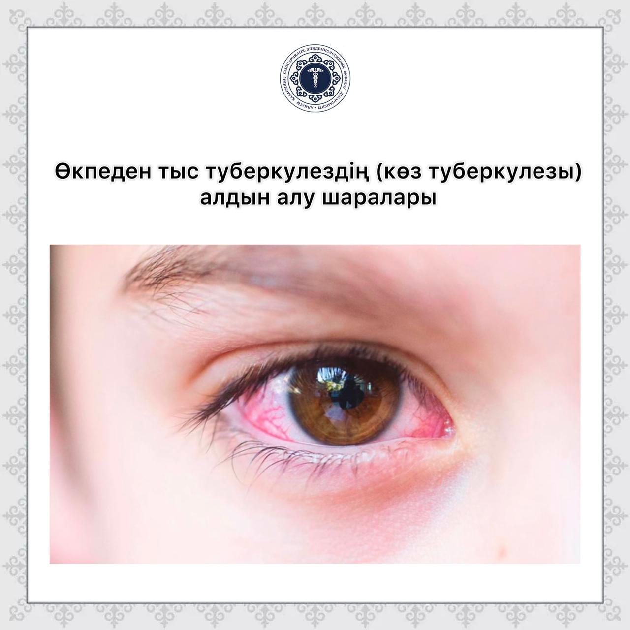 Өкпеден тыс туберкулездің ( көз туберкулезы) алдын алу шаралары