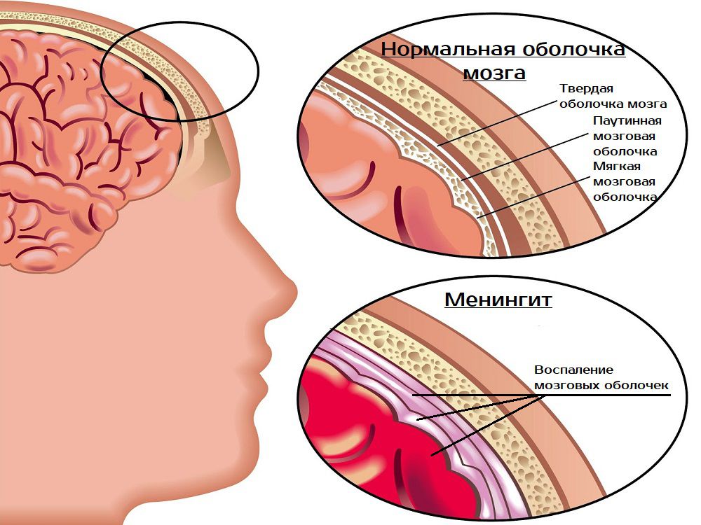 МЕНИНГИТ - өзіңізді және балаңызды қалай қорғауға болады