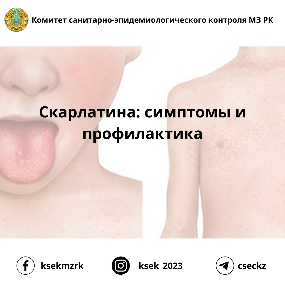 Скарлатина: симптомы и профилактика