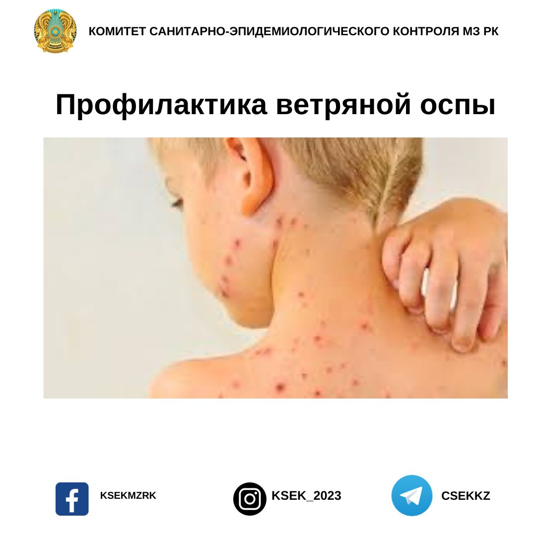 Профилактика ветряной оспы