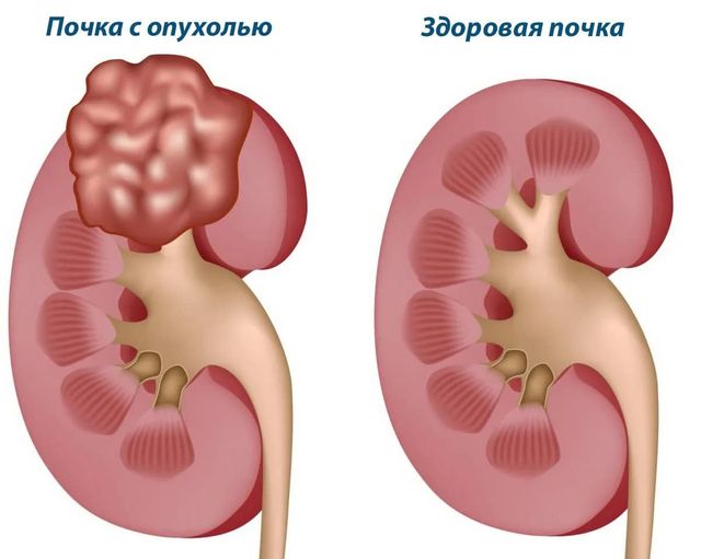 БҮЙРЕК ОБЫРЫНЫҢ ДАМУЫНА ҚАНДАЙ ФАКТОРЛАР ӘСЕР ЕТЕТІНІ ТУРАЛЫ АЛМАТЫ ҚАЛАСЫНЫҢ ОНКОЛОГ ДӘРІГЕРІ АЙТЫП БЕРДІ