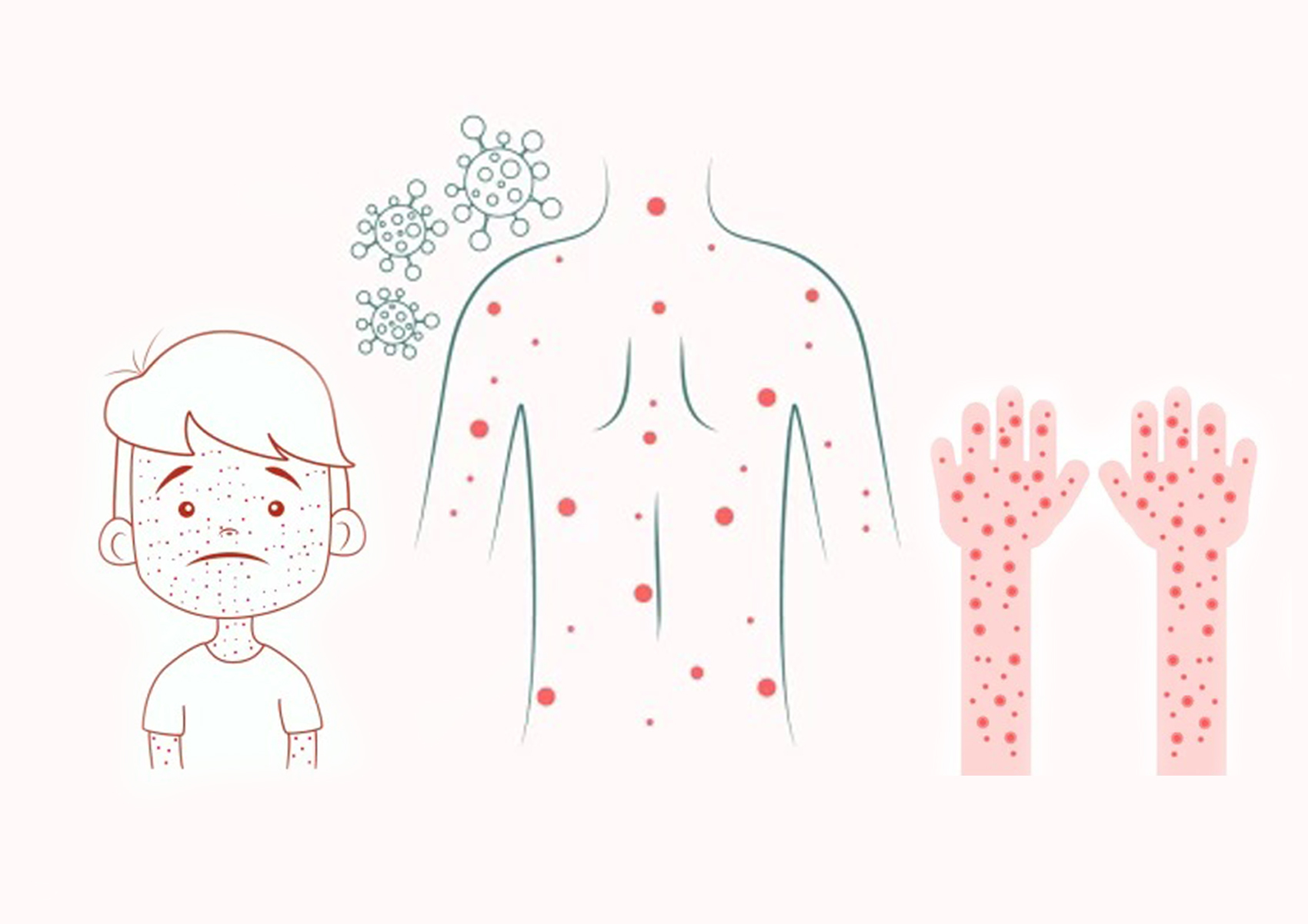 Как выглядит корь на коже Официальный сайт управления здравоохранения Павлодарской области Новости и мат