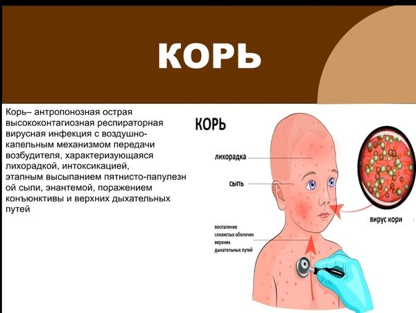 Ақмола облысы бойынша ДСЭК басшысының қызылша ауруы туралы тікелей эфирі