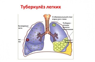 Туберкулездің алдын алу