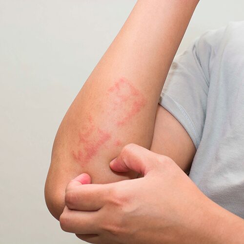 Дерматомикоз және оның алдын алу