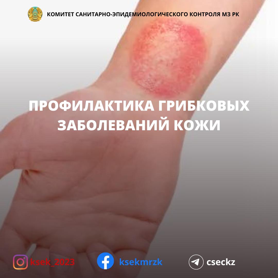 Профилактика грибковых заболеваний кожи