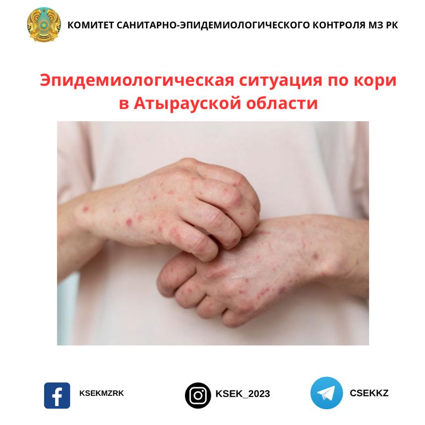 Эпидемиологическая ситуация по кори в Атырауской области