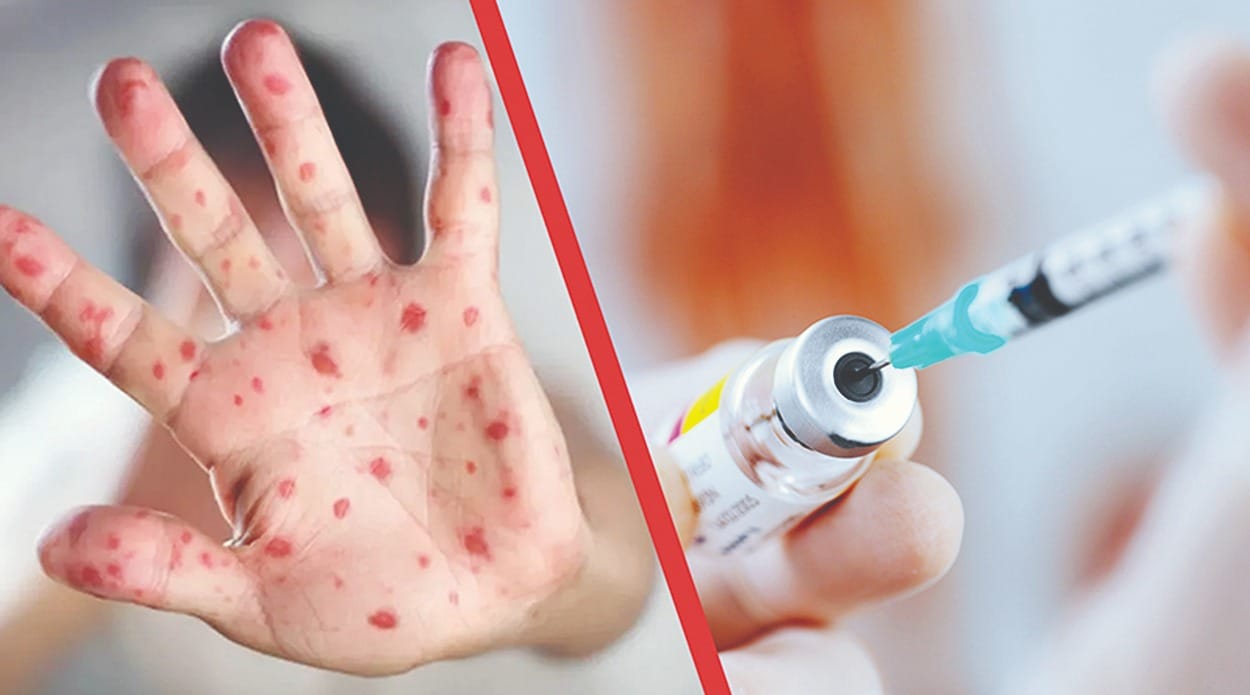 Вакцинация —қызылшаға қарсы халықты қорғау мен және алдын алудың негізгі шарасы