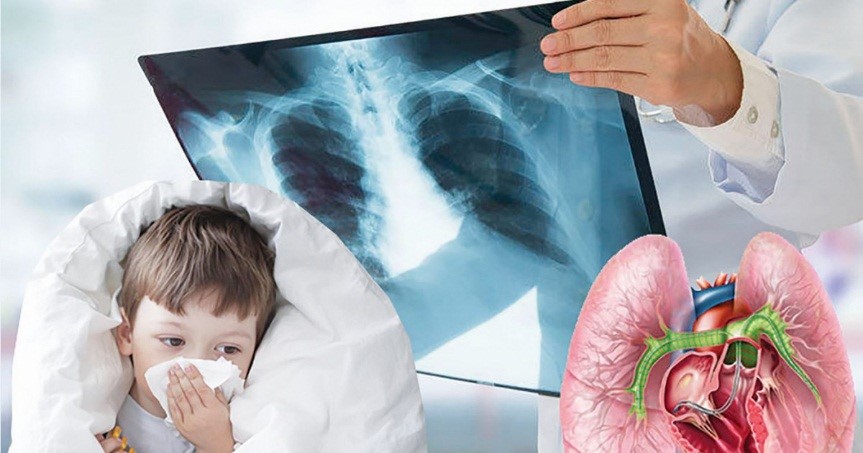 Коклюш и все, что нужно знать о нем