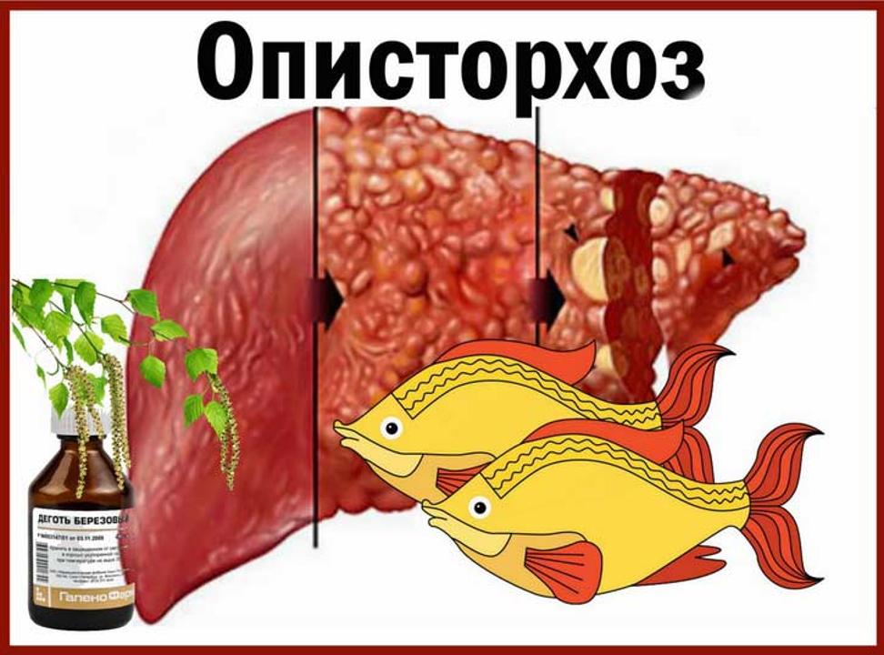 Описторхоз