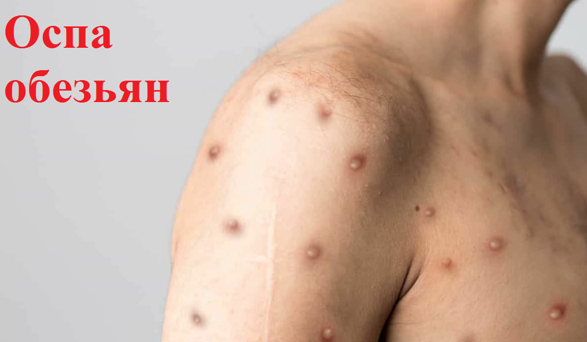 Маймыл шешек дегеніміз не?