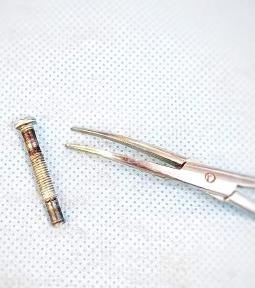 ВРАЧИ ТУРКЕСТАНСКОЙ ОБЛАСТНОЙ ДЕТСКОЙ БОЛЬНИЦЫ СПАСЛИ ЖИЗНЬ 1-ЛЕТНЕМУ РЕБЕНКУ, ВЫТАЩИВ БОЛТ ИЗ ГОРТАНИ