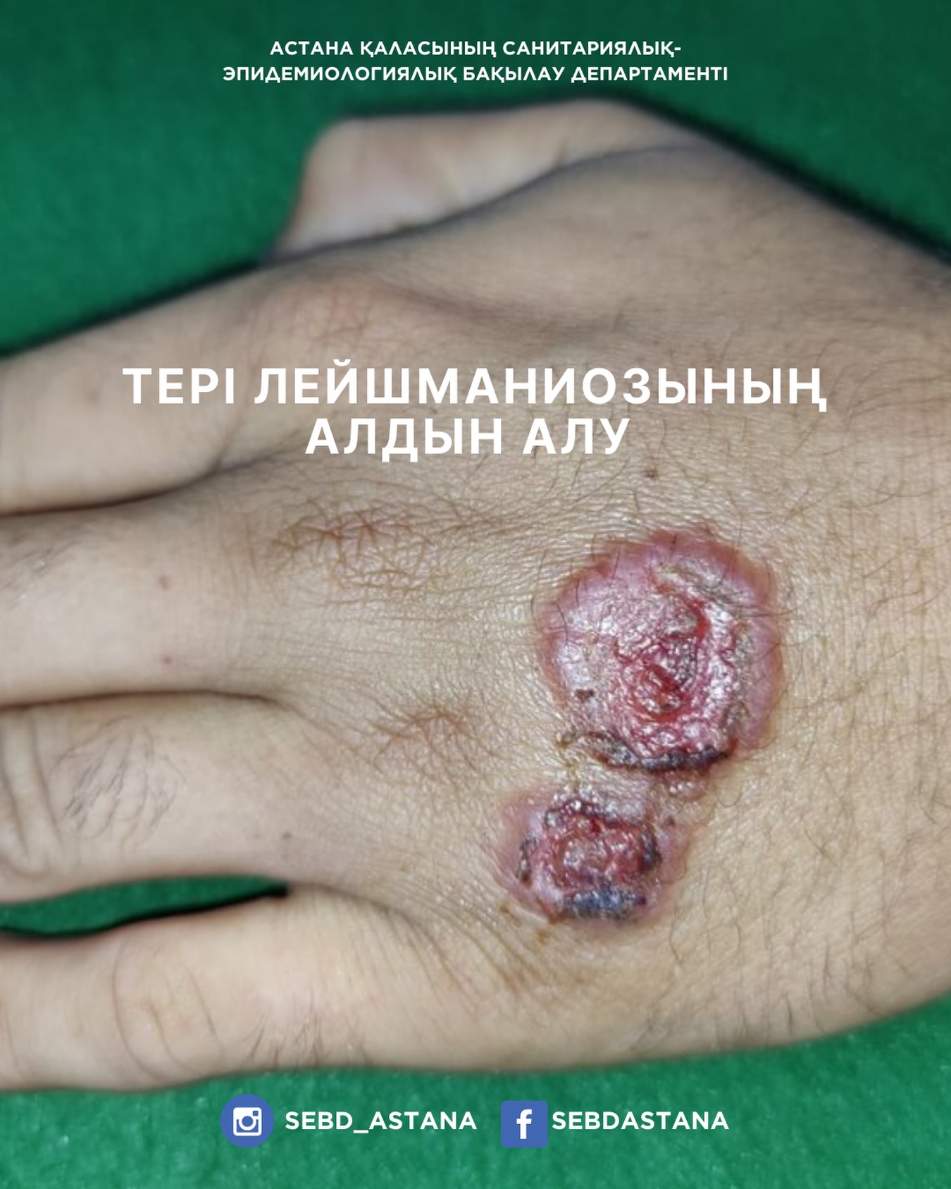 Тері лейшманиозының алдын алу