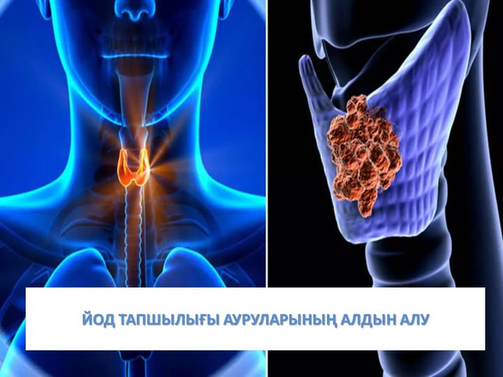 Йод тапшылығы ауруларының алдын алу