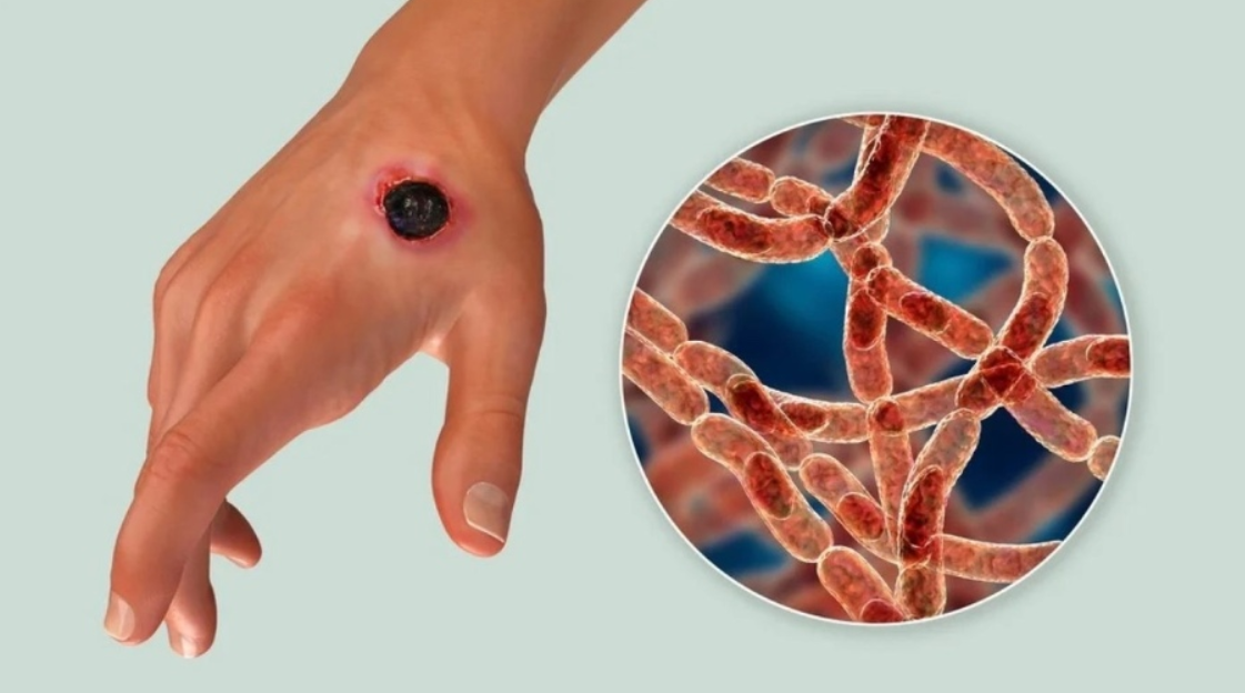 Сібір жарасының алдын алуға байланысты халыққа арналған ұсынымдар