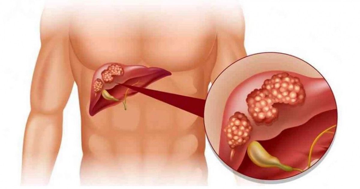 Онкологиялық аурулар