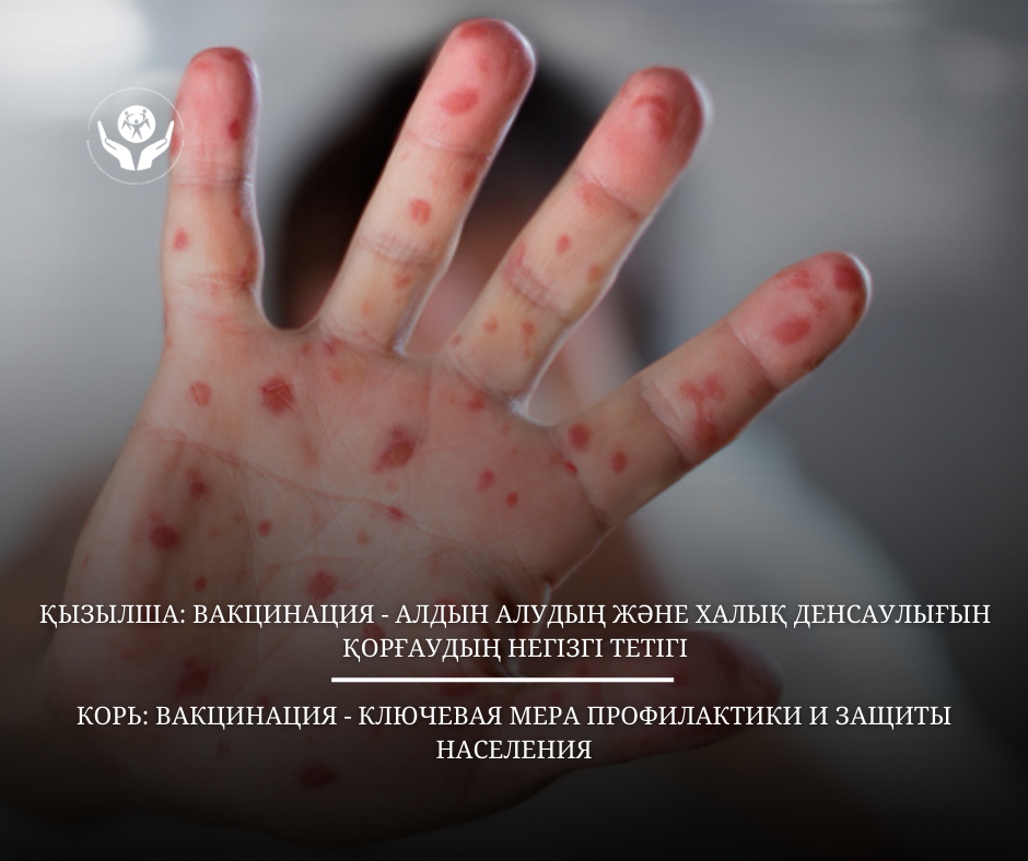 Қызылша: вакцинация — алдын алудың және халық денсаулығын қорғаудың негізгі тетігі