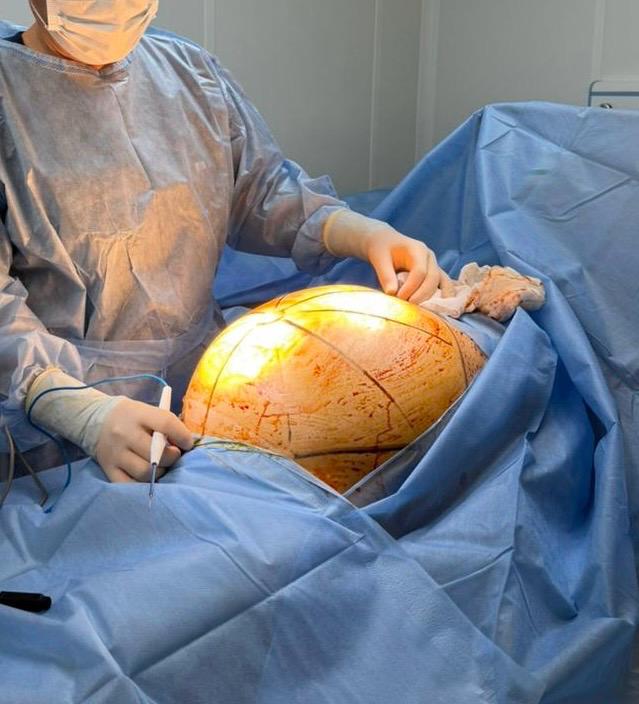 Алматыда 25 келілік ісік алынып тасталды: науқас тағамға қосылатын биологиялық белсенді қоспалармен емделген