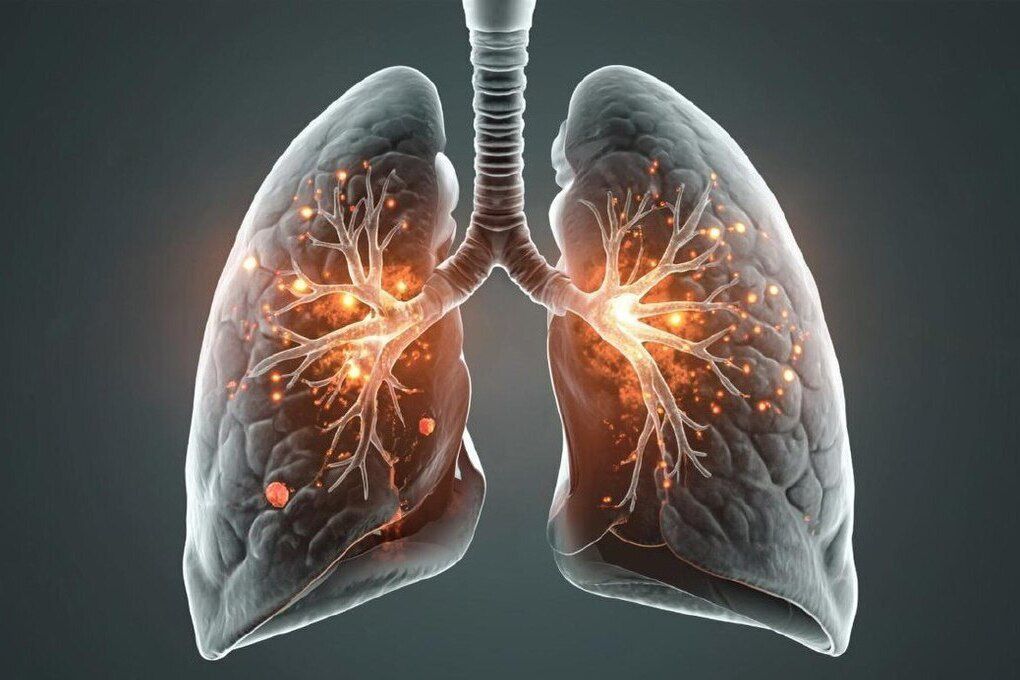 Как защитить себя от туберкулеза