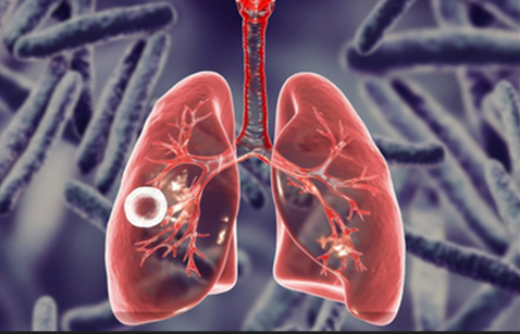 Туберкулездің    алдын алу    айлығы